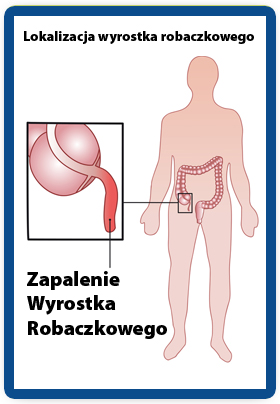 Wyrostek Robaczkowy - a endometrioza